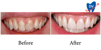 Before and After Dental Veneers in Zagreb, Croatia