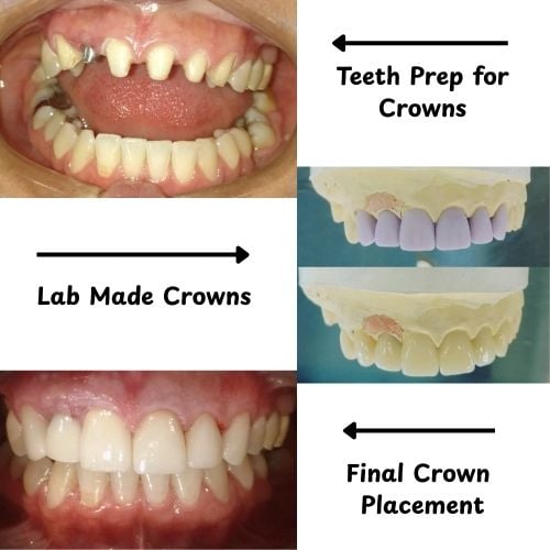 The process of getting dental crowns shown in a partner clinic, Dental 3 Smiles, Tijuana, Mexico