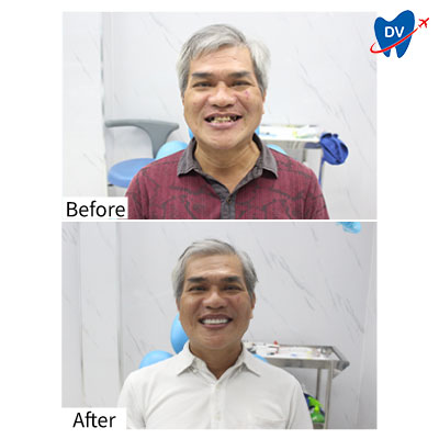 Dental Implants in Vietnam (Before & After)