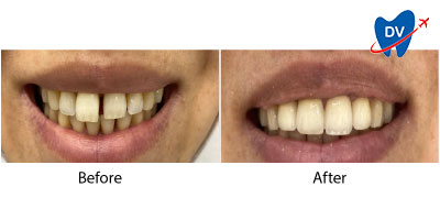 Zirconium Crowns Kusadasi Before & After