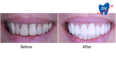 Zirconium Veneers Kusadasi Before & After