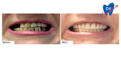 Full Mouth Restoration Los Algodones | Before & After