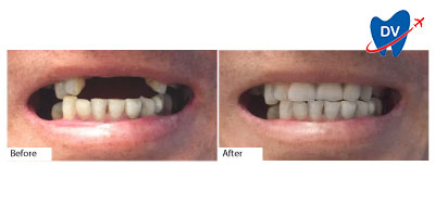 Full Mouth Restoration Los Algodones | Before & After