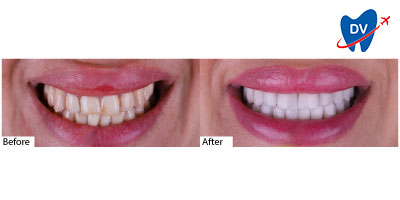 Smile transformation with Istanbul Hollywood Smile