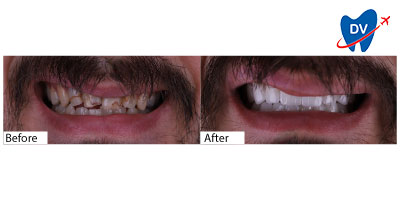 Smile transformation with Istanbul Hollywood Smile