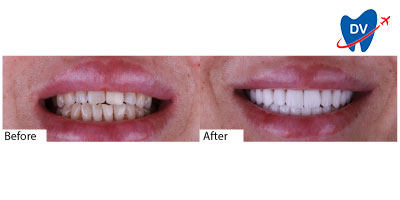 Smile transformation with Istanbul Hollywood Smile