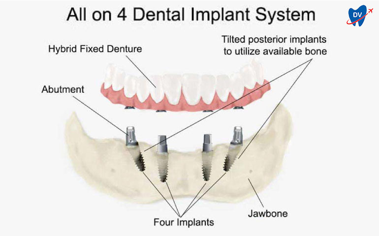 Two titled Posterior implants along with two vertical implants in all on 4 