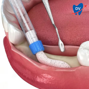 Dental bone graft