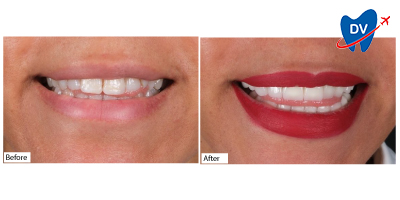 Dental-Veneers-in-Antalya