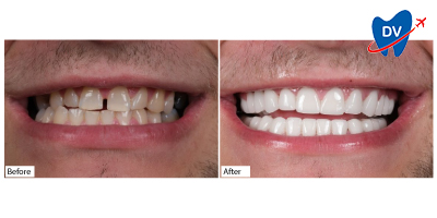 Dental-Veneers-in-Antalya