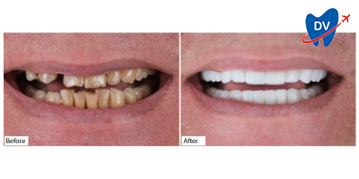 Dental-Veneers-in-Antalya-1