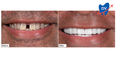 Dental-Veneers-in-Antalya