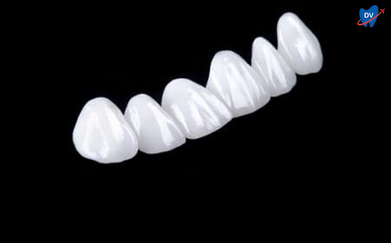 Zirconia-Veneers