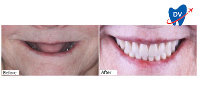 Before and After Dental Implants in Mexico