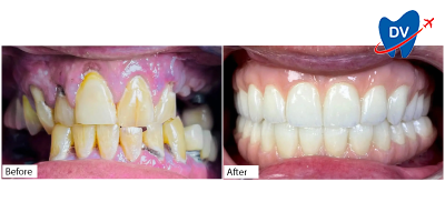 All on 4 in Nogales - Before & After