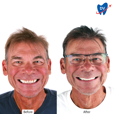 Before & After Dental Crowns in Cancun