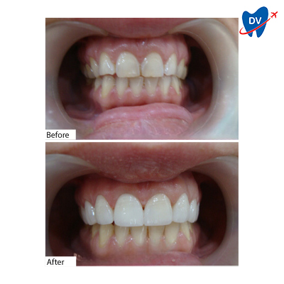 Before and After Dental Veneers | Ho Chi Minh City, Vietnam