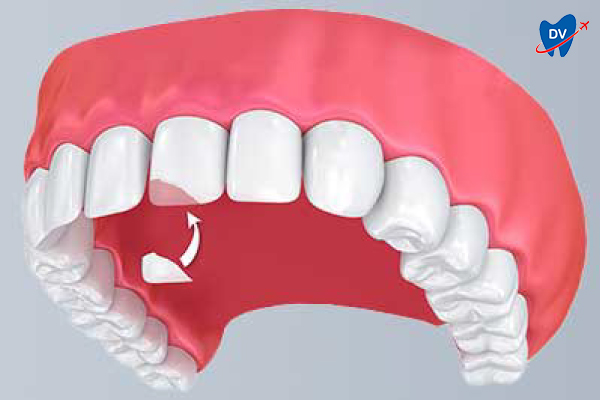 Bonding of Veneers