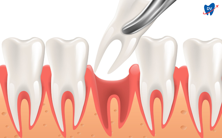 Tooth extraction