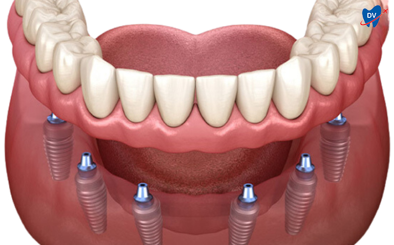 All-on-6 Dental Implants