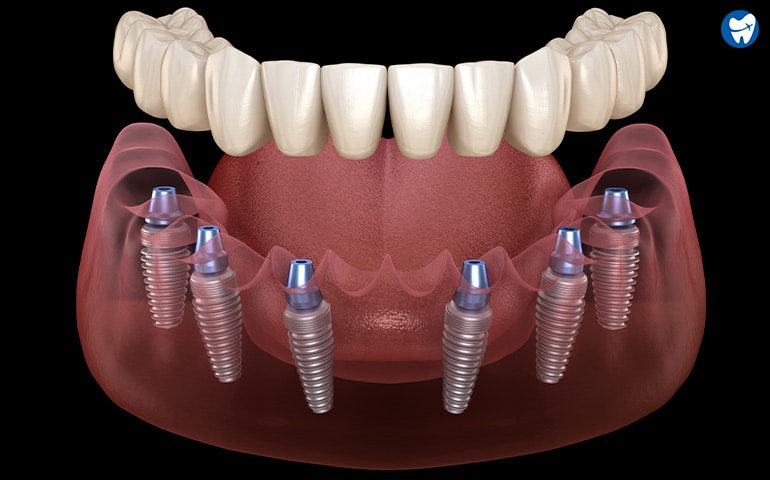 All on 6 Dental Implants in Costa Rica