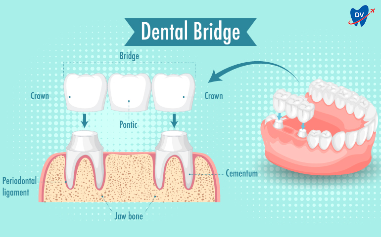 Dental Bridges