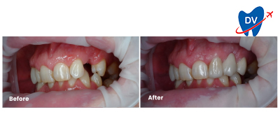 Dental Implants in Indonesia: Before & After