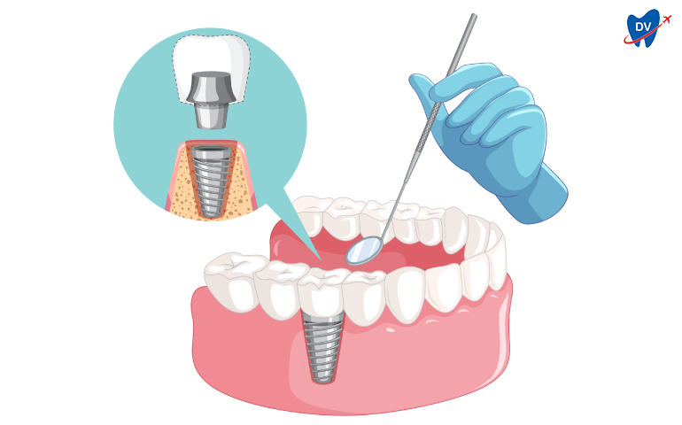 Dental Implants in Costa Rica