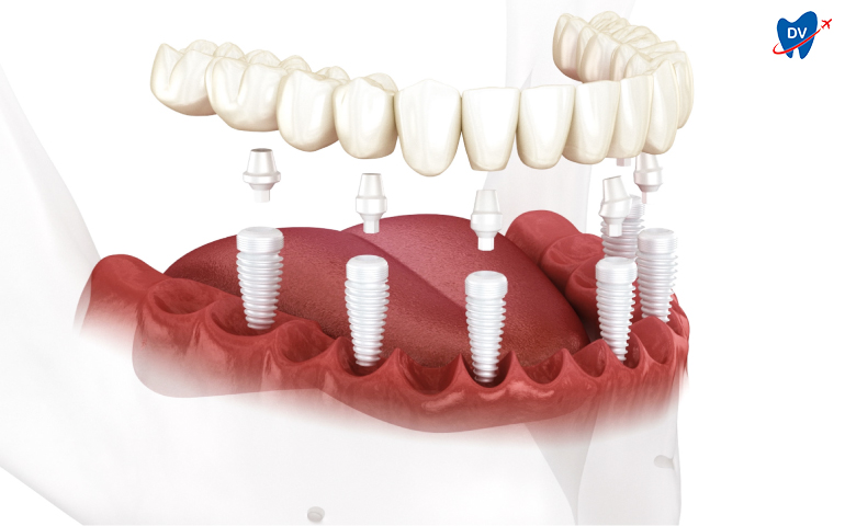 Zirconium Implant