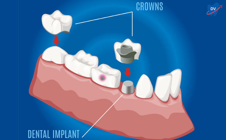 Dental Crown on an Implant and Damaged Tooth