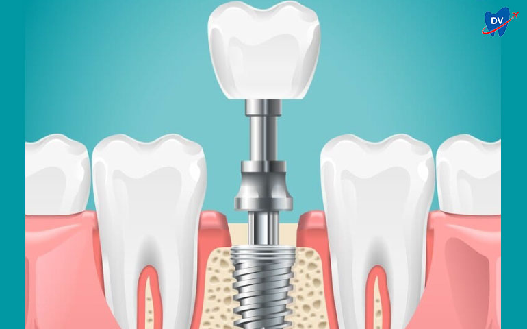 Dental Implants Replace Tooth Roots