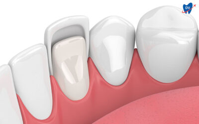 Zirconia Veneers