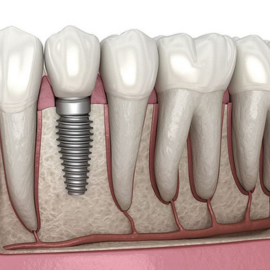 Dental Implant