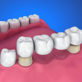 Dental Bridge