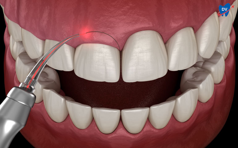 Gum Contouring 