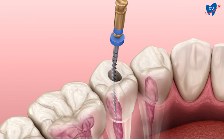 Root canal in Mumbai