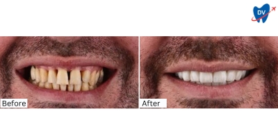 Before and After Veneers in Bodrum, Turkey