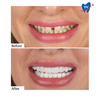 Dental Crowns in Antalya, Turkey - Before & After Dental Crowns in Antalya, Turkey - Before & After