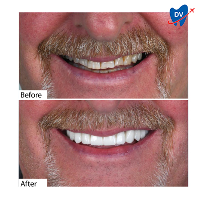 Dental Crowns in Antalya, Turkey - Before & After Dental Crowns in Antalya, Turkey - Before & After