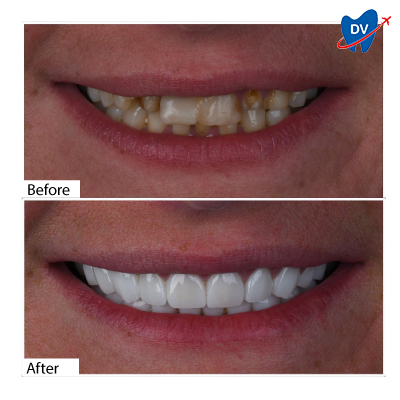 Dental Crowns in Antalya, Turkey - Before & After Dental Crowns in Antalya, Turkey - Before & After