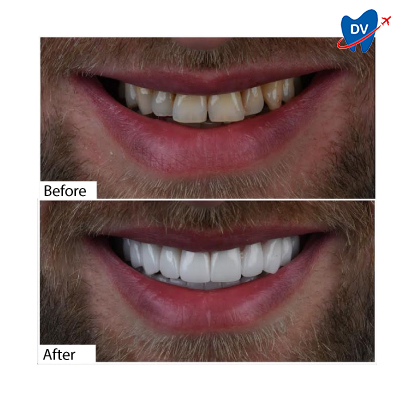 Dental Crowns in Antalya, Turkey - Before & After Dental Crowns in Antalya, Turkey - Before & After