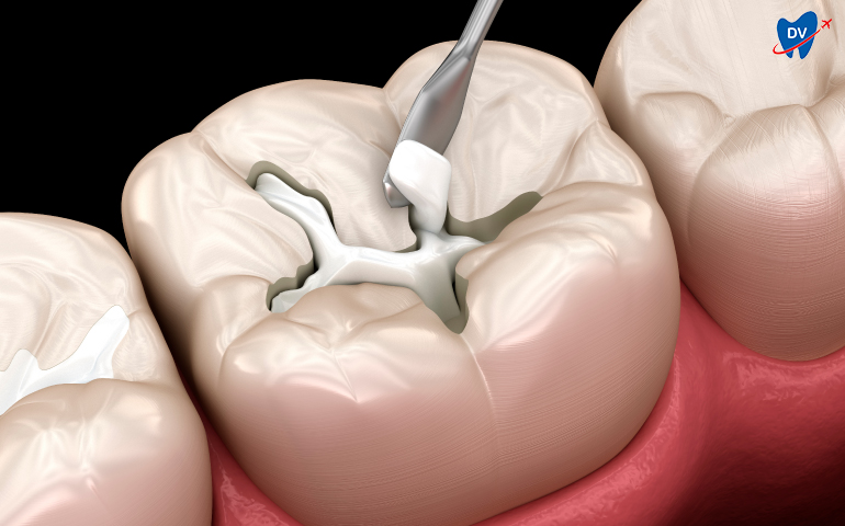 Composite filling