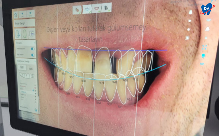 Digital Smile Design in Kusadasi Turkey