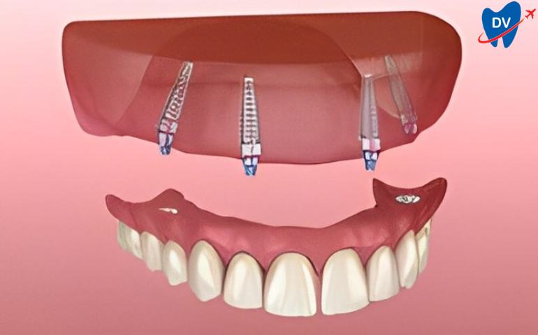 All-on-4 Dental Implants