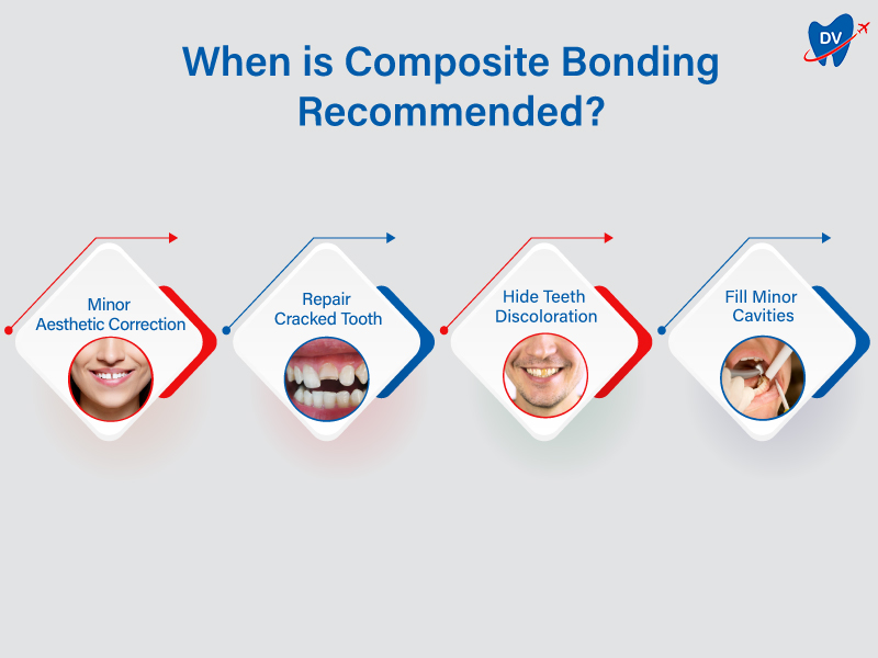 Composite Bonding Recommendations Composite Bonding Recommendations