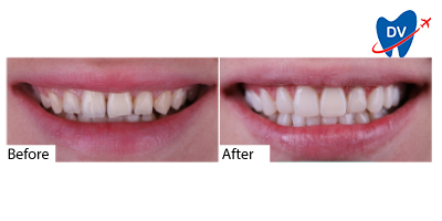 Composite Veneers Istanbul Before & After