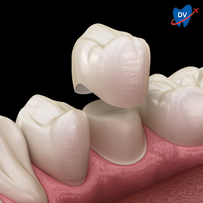Dental Crown Dental Crown