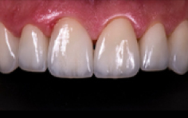 E-Max-Veneers