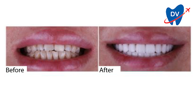 Emax Veneers Istanbul Before & After