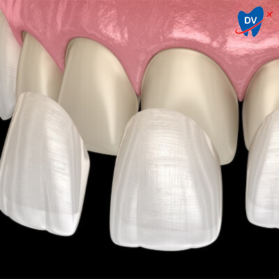 Porcelain Veneer Porcelain Veneer